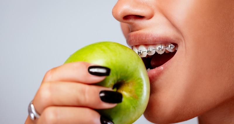 Nên ăn gì sau khi niềng răng để bảo vệ răng miệng